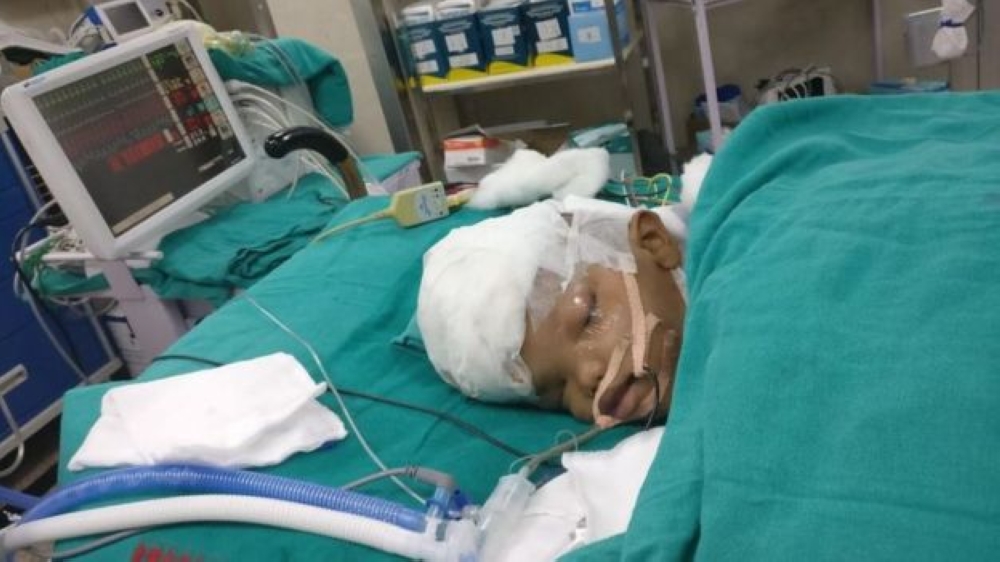 نجاح عملية نادرة لفصل توأم ملتصق من الرأس