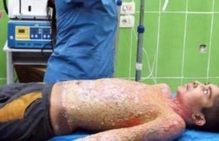 صرخات تفطر القلب.. طفل كردي محروق بأسلحة تركية