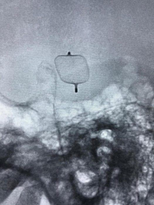 "الملك حمد الجامعي" ينقذ حياة مريض من انفجار شريان بالمخ