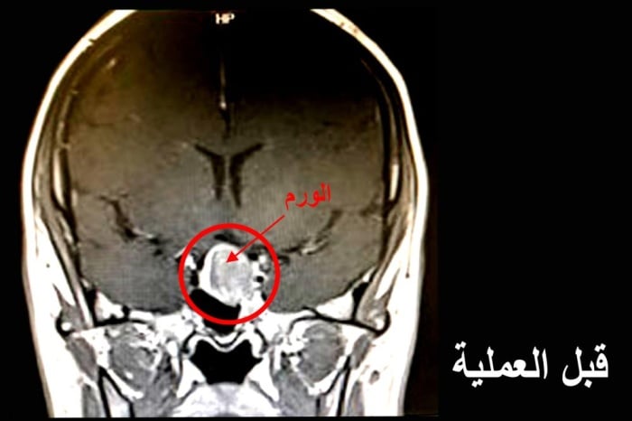 "حمد الجامعي" يستأصل ورم من رأس إمرأة بحرينية عن طريق الأنف