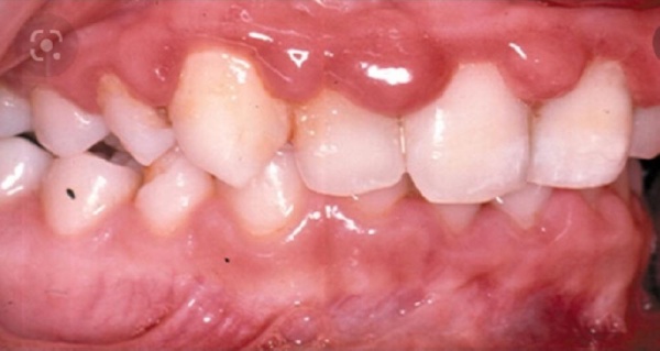 الطحان: الاهتمام بأسنان الأطفال يبدأ منذ مرحلة الأجنة