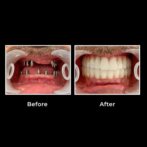 تركيب الأسنان