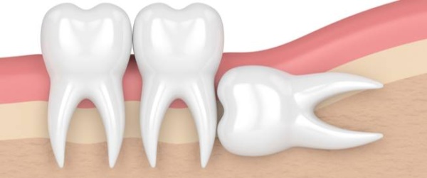أضراس العقل.. كابوس عيادات الأسنان