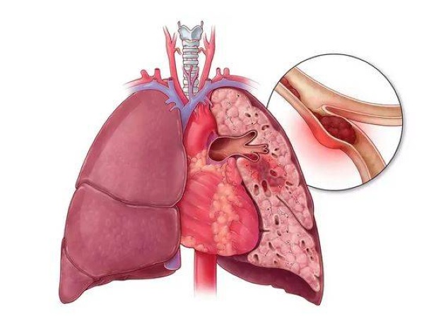 6 طرق لتشخيص الجلطة الرئوية