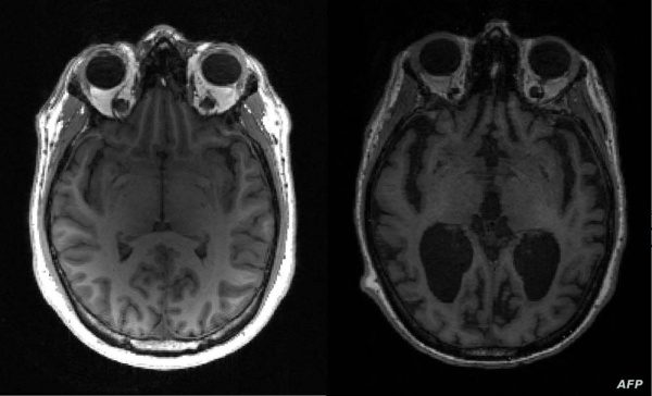 كتشاف «سبب جديد تماما» لمرض الزهايمر