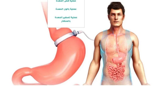 د. فيصل المحروس لـ"الوطن": ٪50 ممن أجروا عملية تكميم المعدة أصيبوا بحصوات المرارة