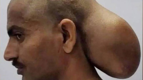 هندي عاش برأسين لمدة 15 عاماً.. ما قصته؟