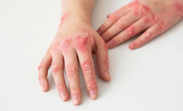 طبيب مصري يحذر من مرض جلدي خطير.. ويكشف أسبابه