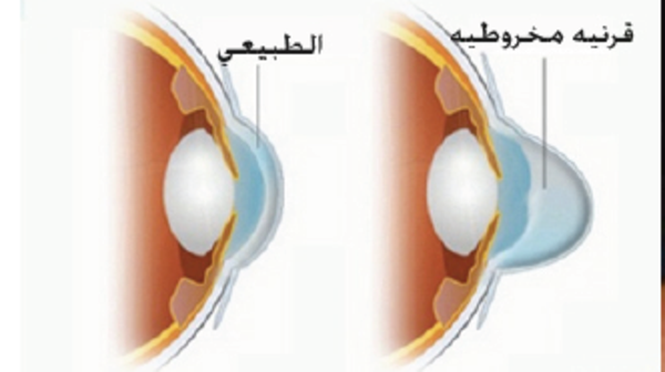 دكتور سعودي يتوصل لعلاج جديد للقرنية الضعيفة