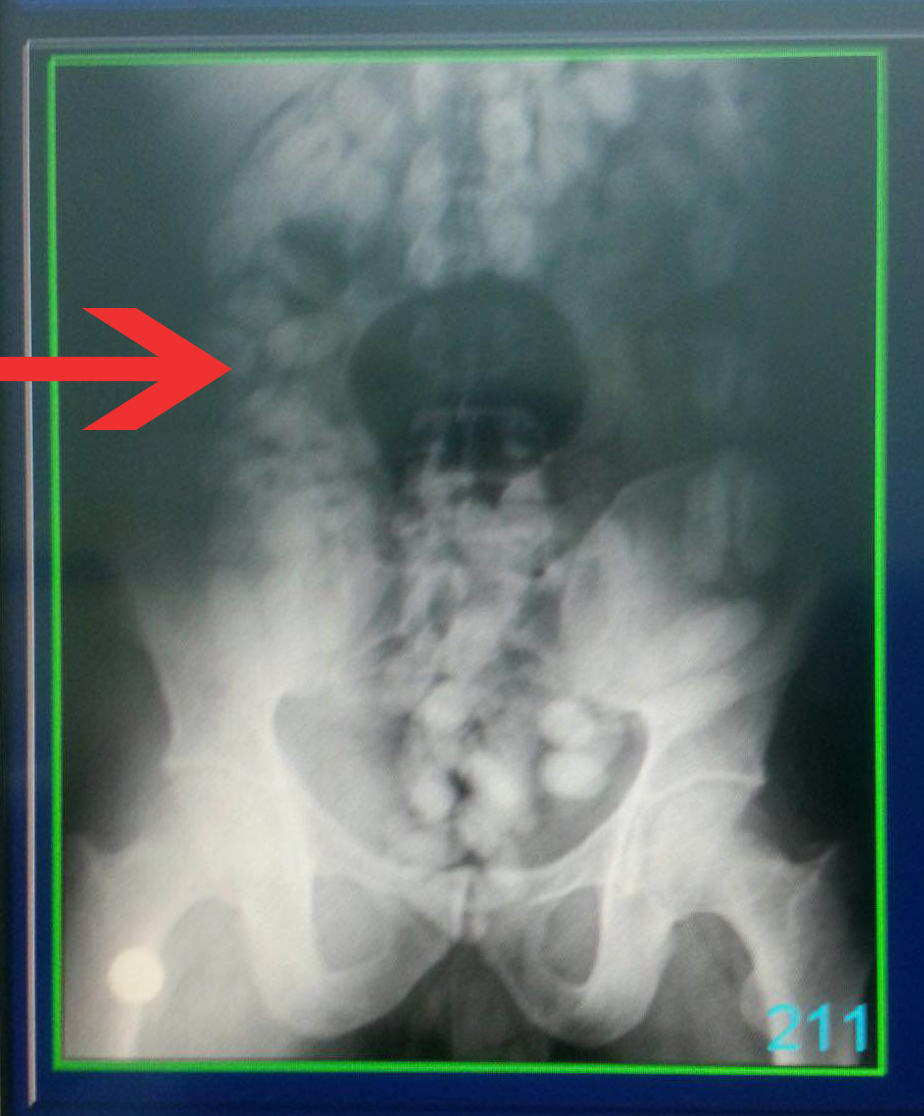 جمارك المطار تقبض على آسيوي حاول تهريب 100 كبسولة هيروين في أحشائه