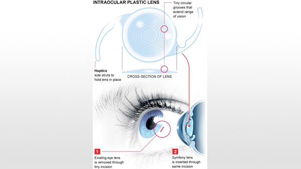 اختراع ثوري: عدسة بـ6 آلاف دولار تحل مشاكل الرؤية