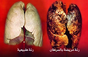 علاج لترقق العظم فعال في مكافحة سرطان الرئة والثدي