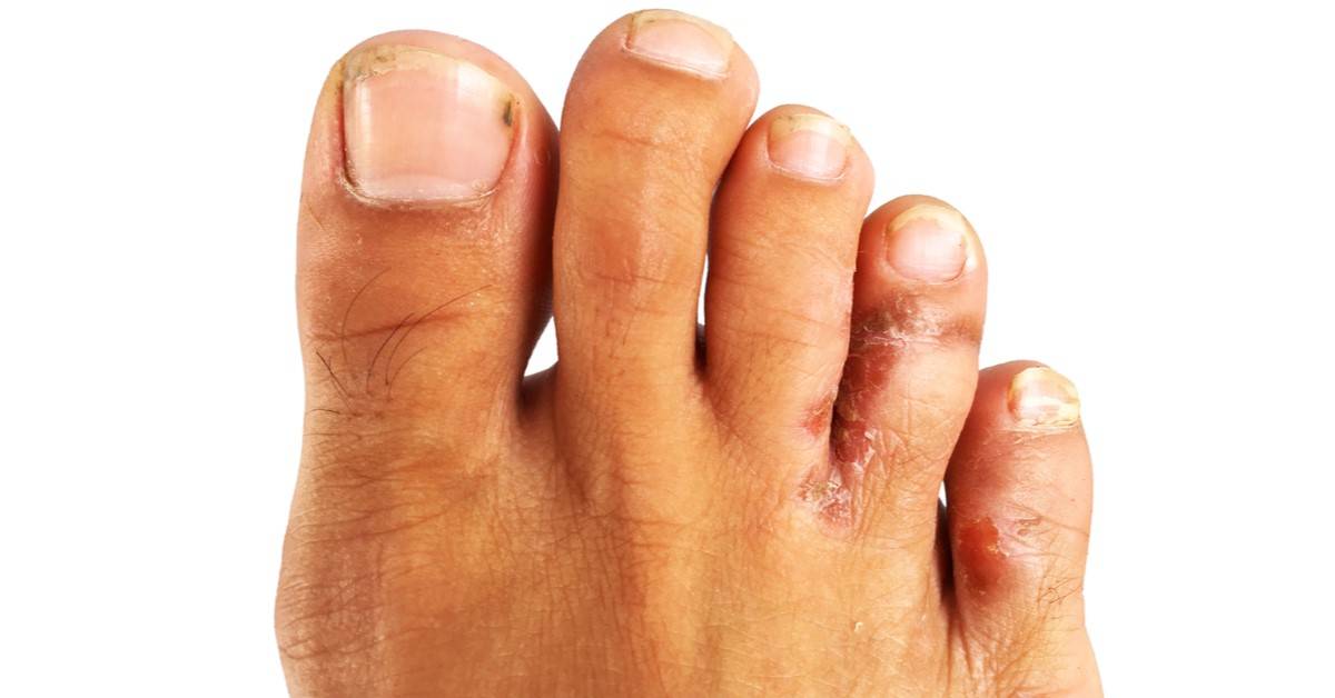 قدميك تكشف أسرار صحتك.. علامات تحذيرية لا تتجاهلها