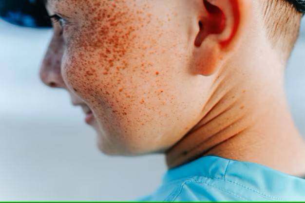 أسباب فرط إفراز الميلانين في الجلد.. بعضها هرموني