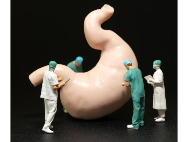 شروط عملية تكميم المعدة ودورها في مكافحة السمنة