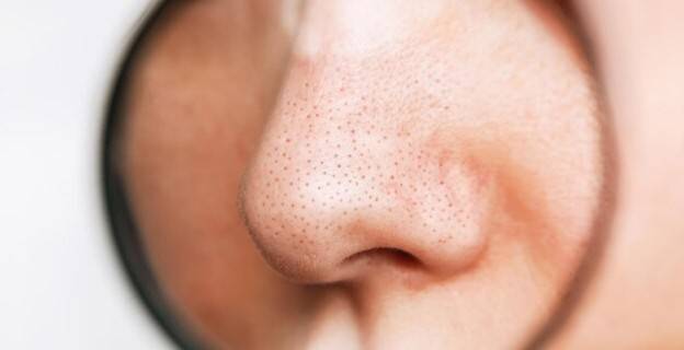 أسباب ظهور الرؤوس السوداء في الوجه