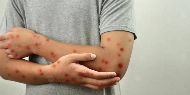 أعراض جدري القرود.. كيف تعرفها وتحمي نفسك منها؟