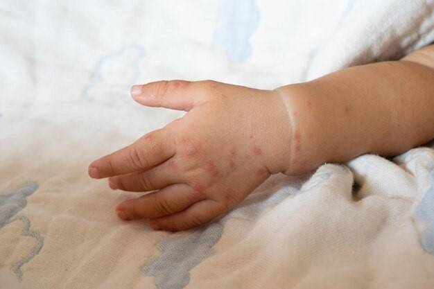 هل يمكن علاج الجدري المائي عند الأطفال؟