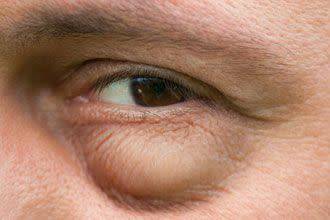 علاجات منزلية فعّالة للتخلص من انتفاخات تحت العين