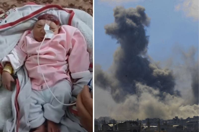 ولادة طفلة "بلا دماغ" في غزة.. مع تزايد ظاهرة تشوه الأجنة في القطاع