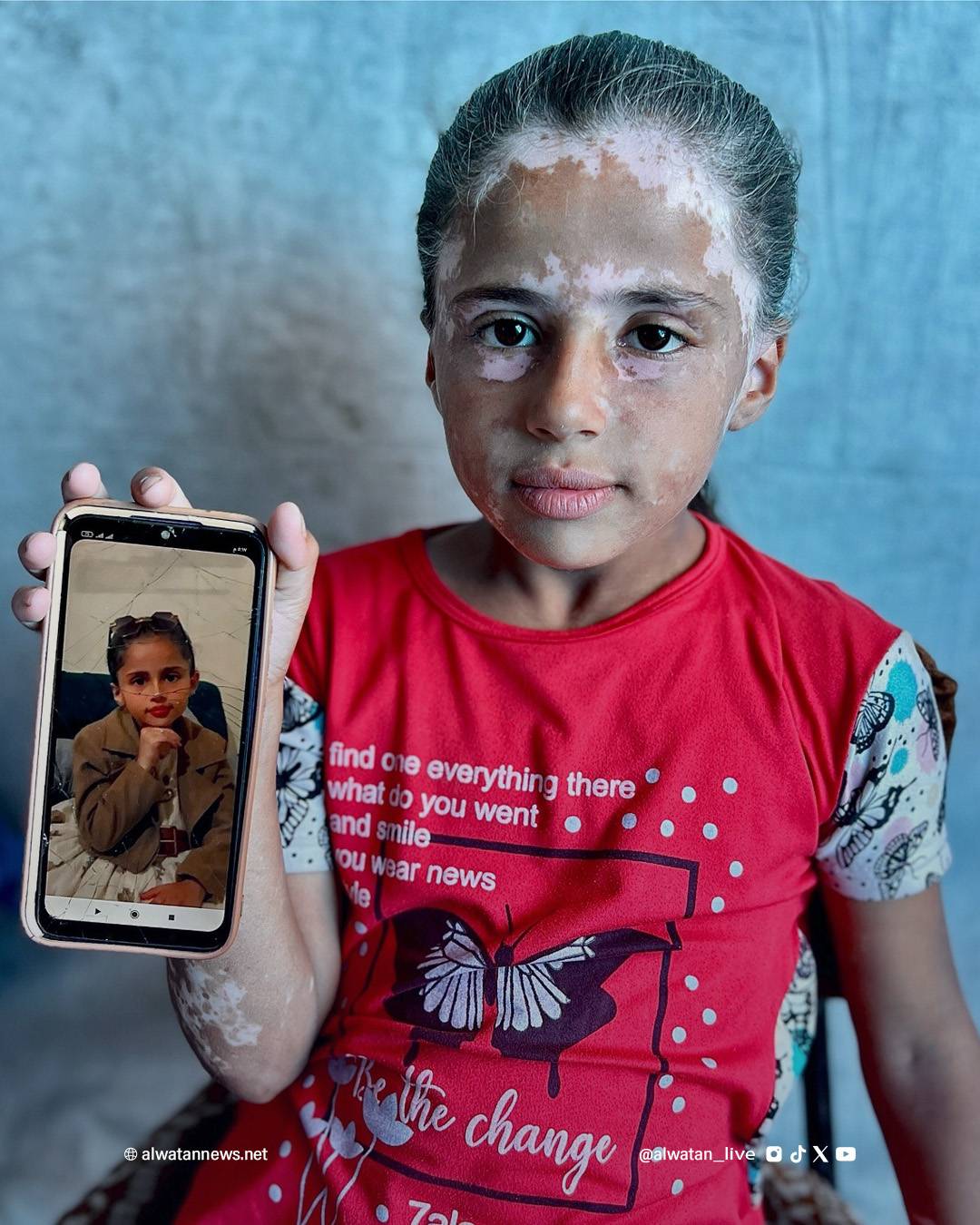 لانا الشريف طفلة من غزة غزاها البهاق بعدما غزاها رعب القصف الإسرائيلي