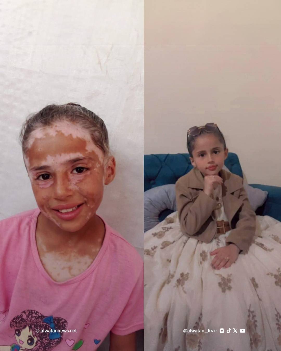 لانا الشريف طفلة من غزة غزاها البهاق بعدما غزاها رعب القصف الإسرائيلي