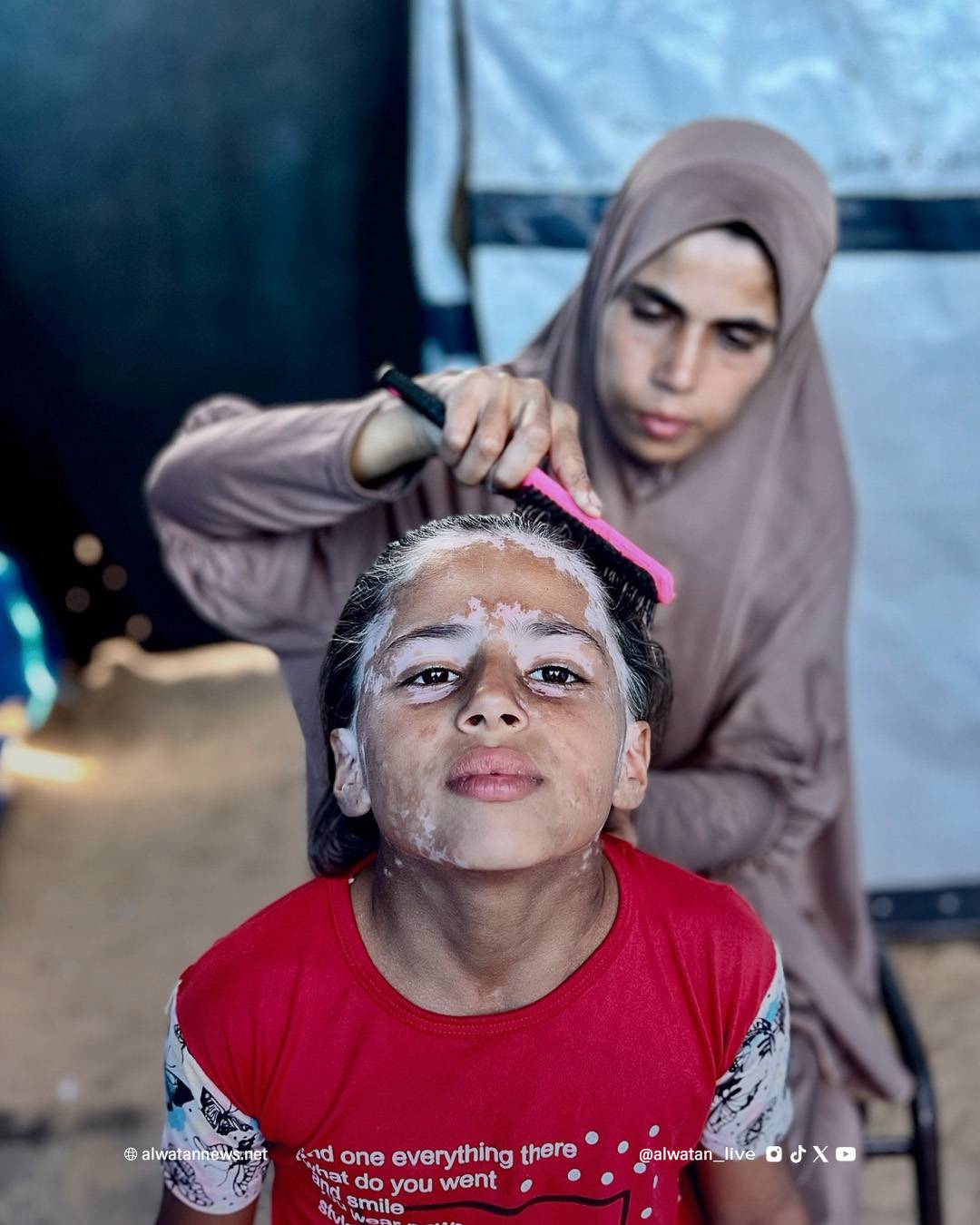 لانا الشريف طفلة من غزة غزاها البهاق بعدما غزاها رعب القصف الإسرائيلي