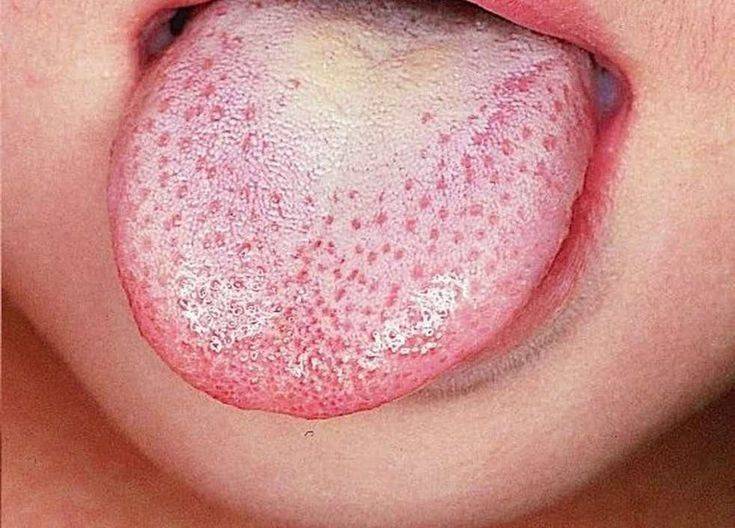 فطريات اللسان عند الأطفال.. الأسباب والوقاية وطرق العلاج