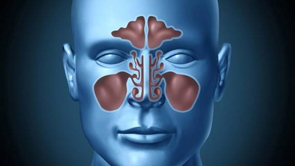 التهاب الجيوب الأنفية المزمن.. أسبابه وأعراضه وكيفية التعرف عليه