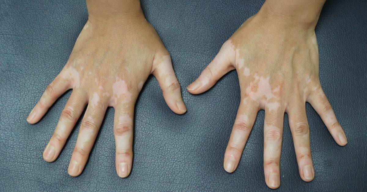 علاج نقص صبغة الجلد.. اعرف الأسباب والطرق الفعّالة لتوحيد اللون