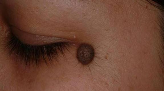 طرق فعالة لإزالة حبة الخال طبيعيا وطبيا