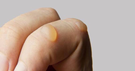 فقاعات الحروق.. اعرف الإسعافات الأولية وطرق العلاج