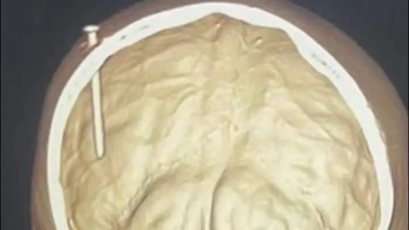 جراحة دقيقة لاستخراج مسمار اخترق جمجمة طفل في الفيوم