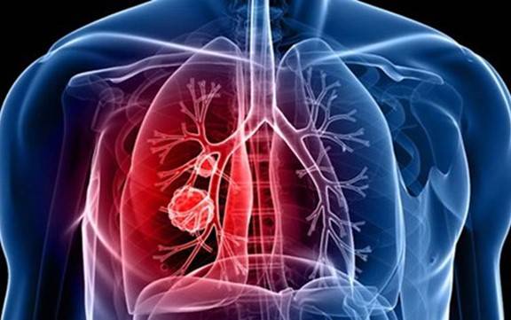 أسباب ارتفاع ضغط الدم الرئوي وطريقة العلاج