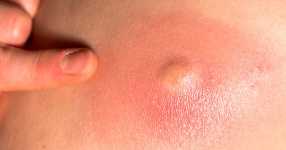 أسرار التخلص من الخراج في المنزل والوقاية منه بفعالية ومتى يتدخل الطبيب