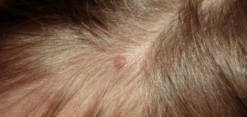 سرّ نمو بصيلات الشعر وعلاج التهابها منزليًا ومتى نلجأ للجراحة