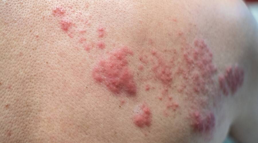 القوباء.. عدوى جلدية معدية تصيب الأطفال بشكل رئيسي وحالة واحدة تستدعي التدخل الطبي