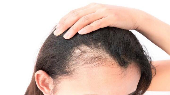 وداعًا للحكة والقشور.. أفضل العلاجات المنزلية لصدفية الشعر