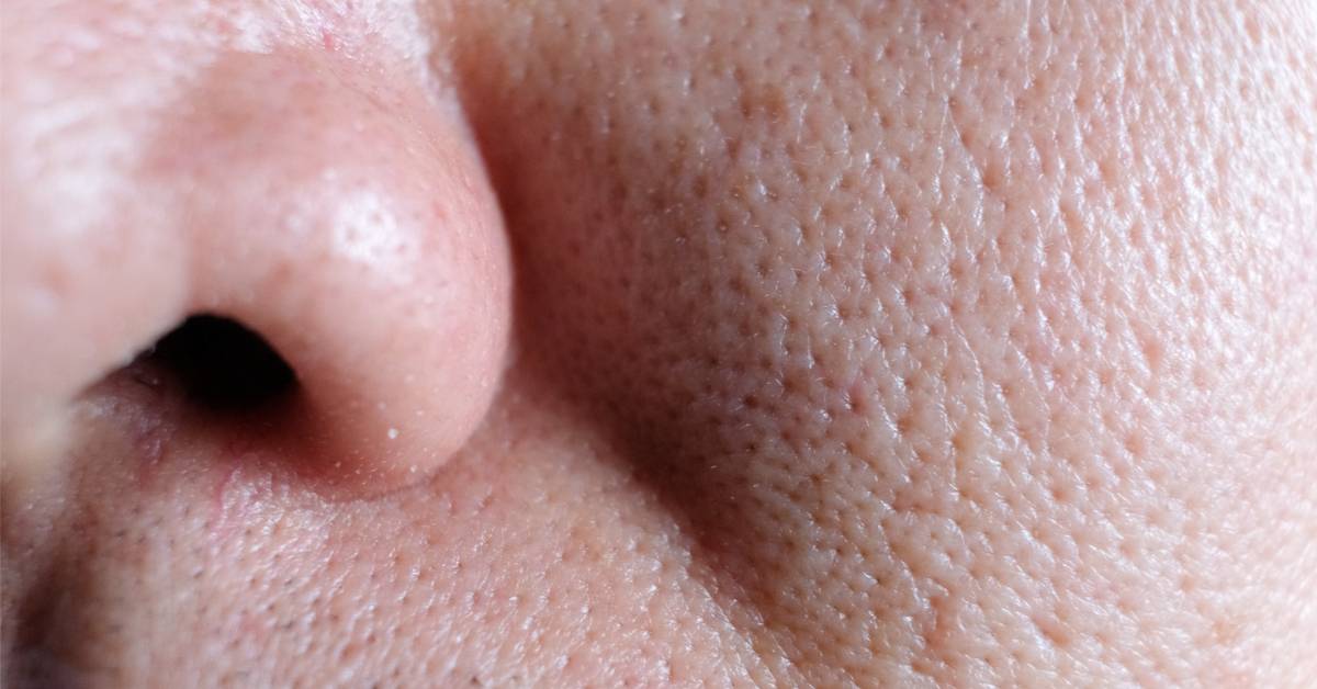 علاجات طبية ووصفات طبيعية وعادات يومية لتصغير مسامات وجهك