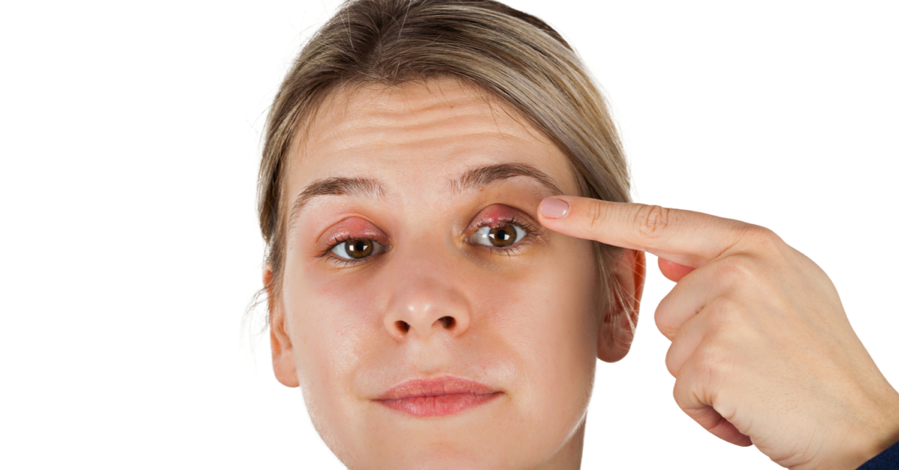 أسباب ظهور الكيس الدهني فوق العين وطريقة علاجه بوصفات طبيعية