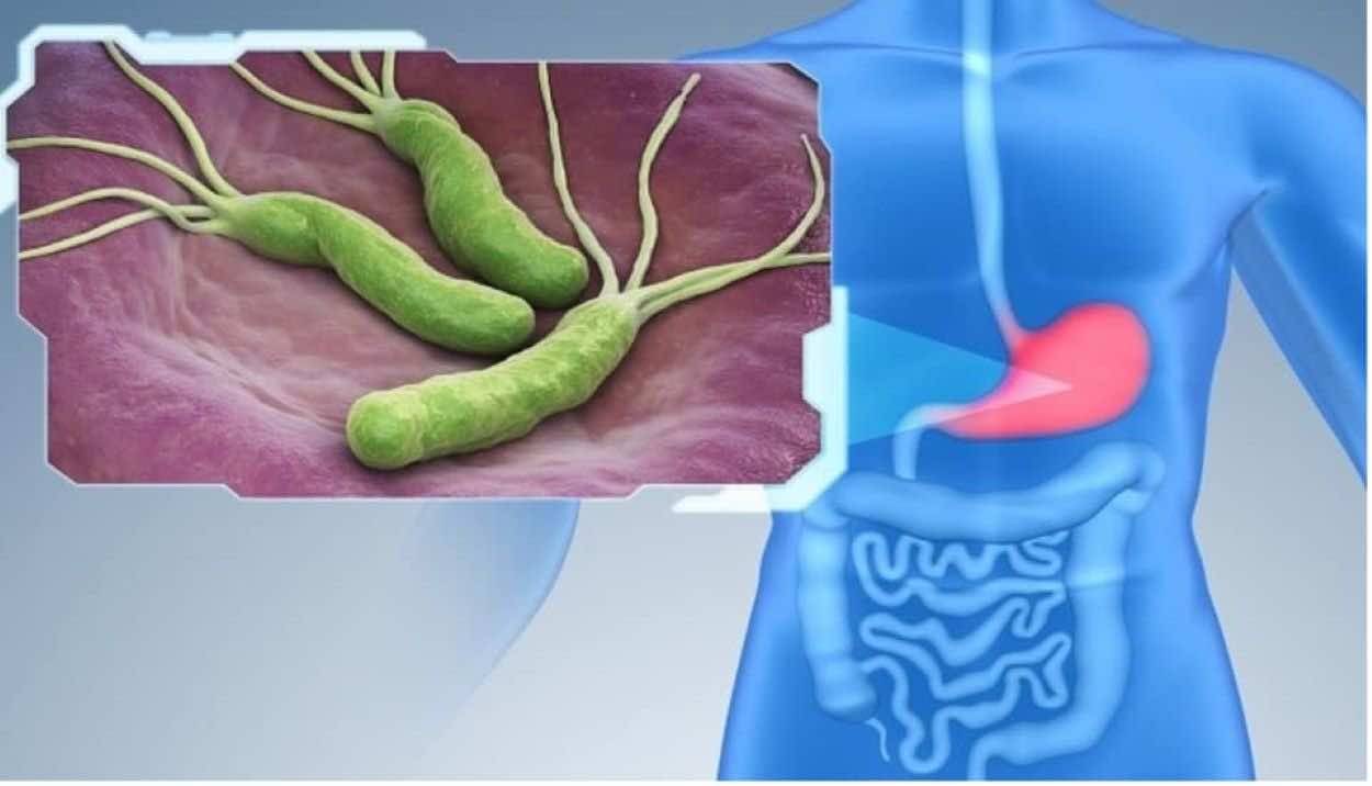 ما هي جرثومة المعدة وطرق علاجها؟