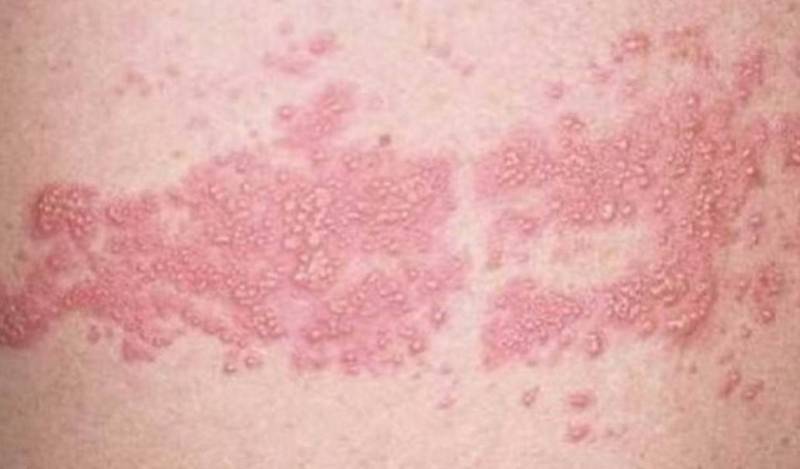 الحزام الناري.. مرض فيروسي يُصيب الأعصاب ويهدد كبار السن بمضاعفات خطيرة