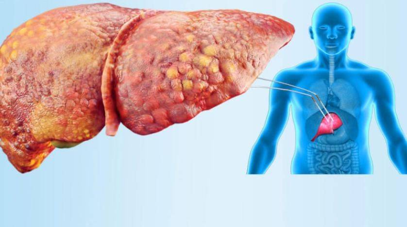 ما هو الكبد الدهني وكيف يمكن علاجه؟