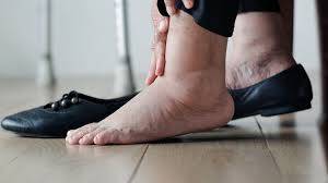 تورم القدمين عند النساء.. بين الأسباب الطبيعية والدلالات الصحية الخطيرة