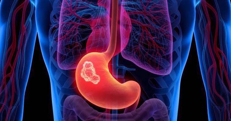 ما هي أعراض سرطان المعدة؟ وهل تختلف عن القرحة؟