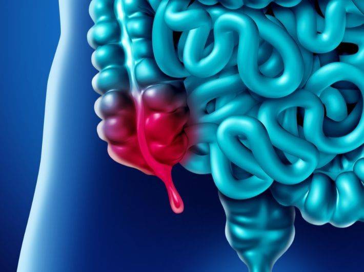 ما هي أسباب التهاب الزائدة الدودية؟ ومتى يجب اللجوء للجراحة؟