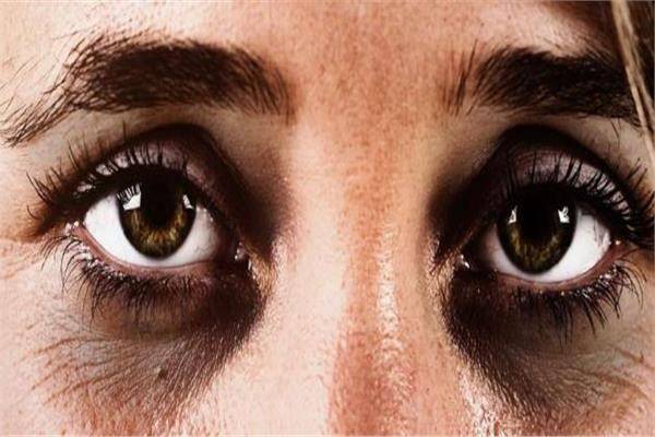 ما أسباب الهالات السوداء تحت العين.. اعرف طرق العلاج