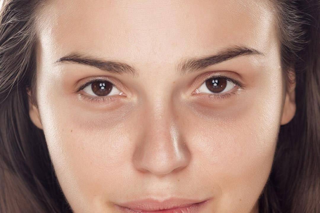 ما أسباب الهالات السوداء تحت العين.. اعرف طرق العلاج