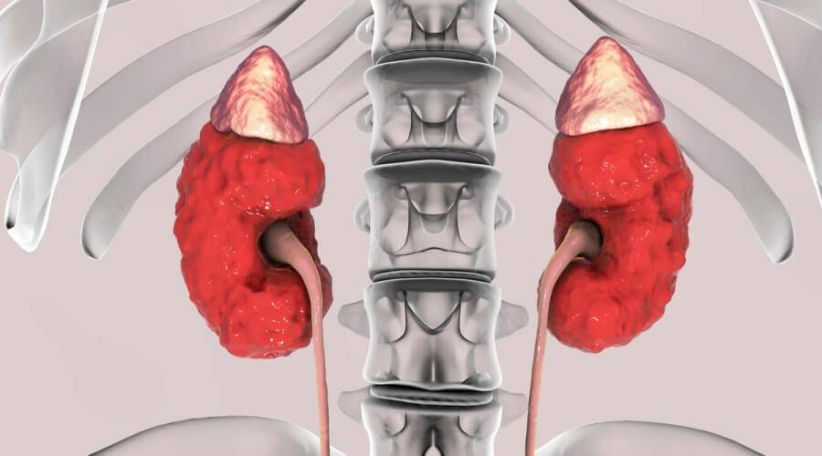 الفشل الكلوي الحاد والمزمن.. اعرف الفرق بينهما وكيفية التعامل مع كل حالة