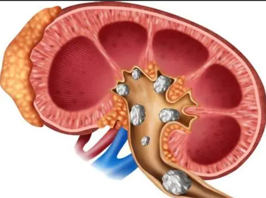 أبرزها النقرس وقلة شرب الماء.. ما هي أسباب حصوة الحالب؟